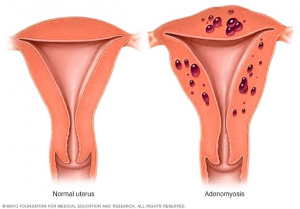adenomyosis vs normal uterus