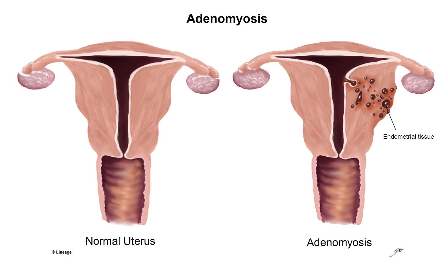 adenomyosis