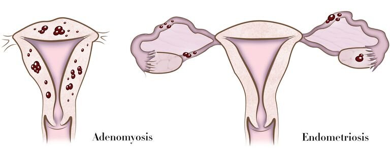 Adenomyosis versus Endometriosis